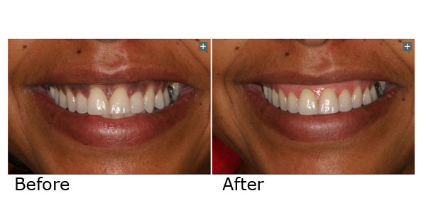 Attractive Gums - Gum Bleaching