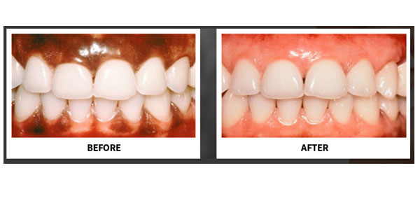 ppealing Lips - Improving Gummy Smile