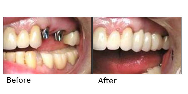 Dental Implant Restoration