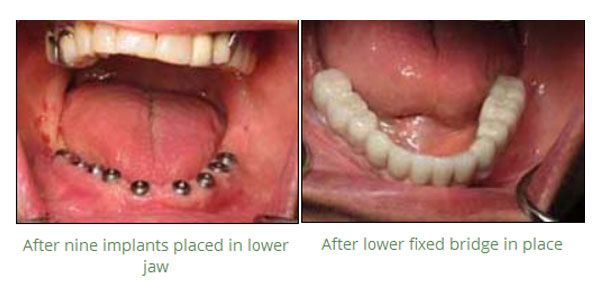 Tooth Crowns and Veneers