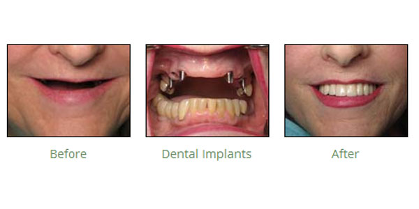 Smile Makeover