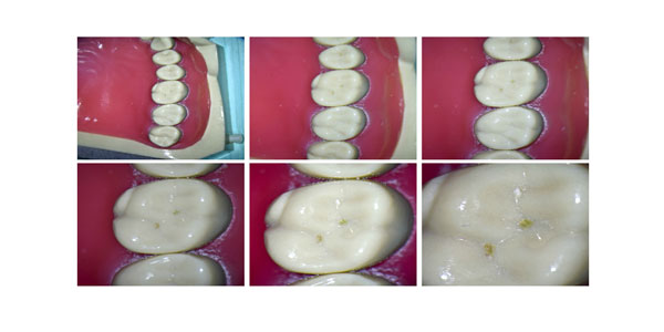 Attractive Gums - Gum Bleaching
