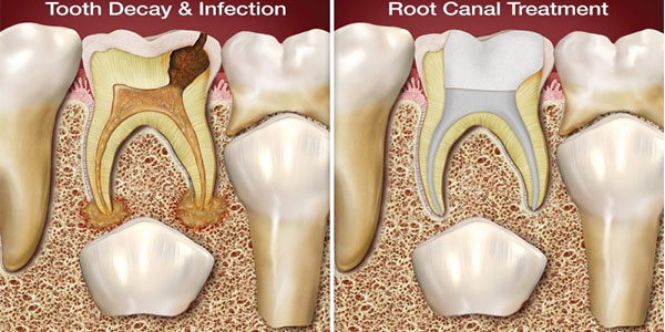 Attractive Gums - Gum Bleaching
