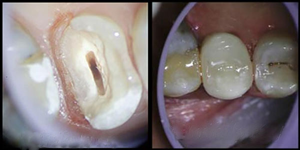 Tooth Colored Fillings