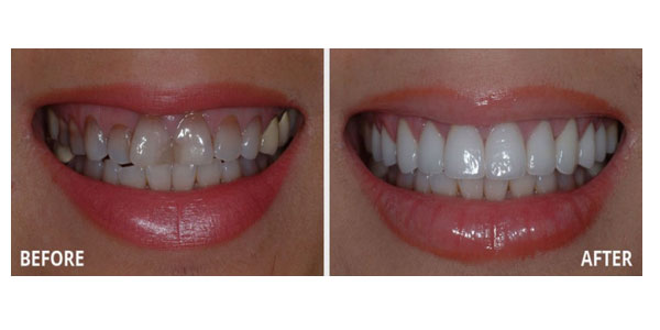 Smile Makeover