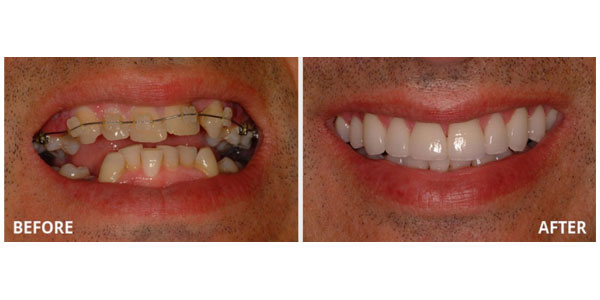  Attractive Gums - Gum Bleaching 