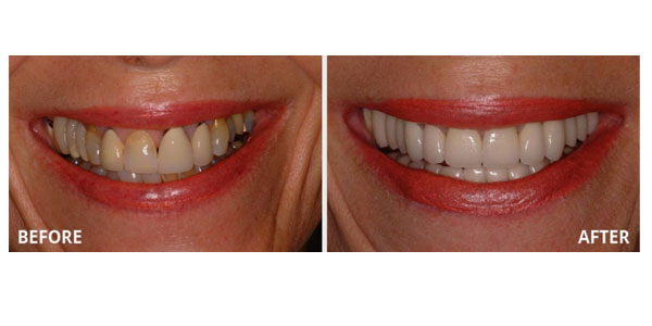 Attractive Gums - Gum Bleaching 