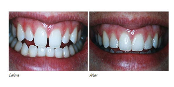 Tooth Bonding