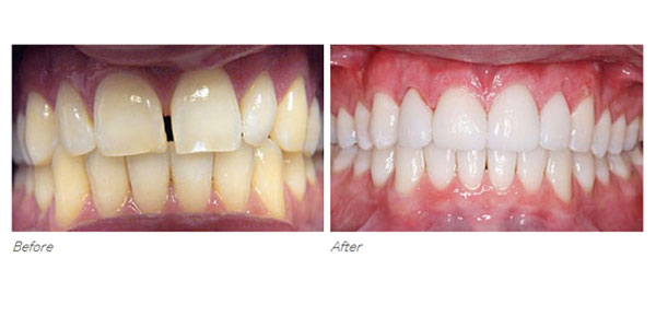 Porcelain Crowns