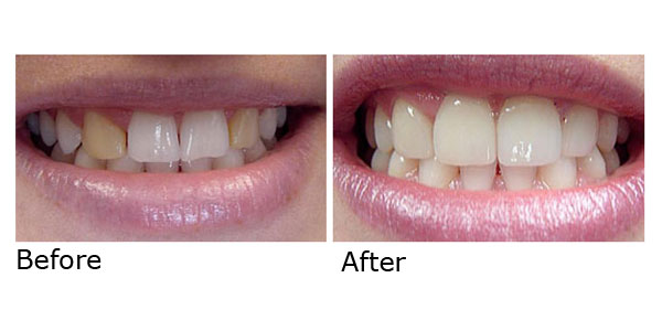Porcelain Crowns